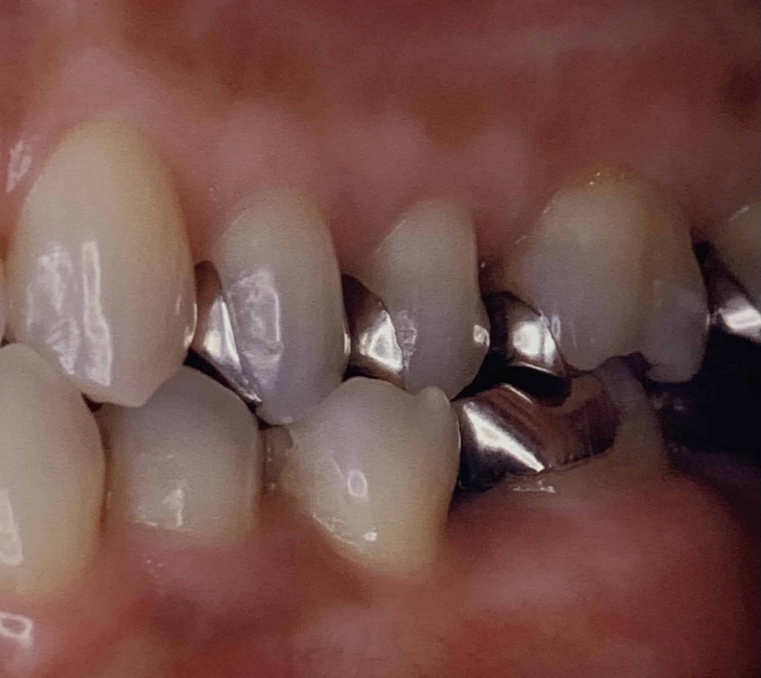 銀 歯 虫歯 に なる